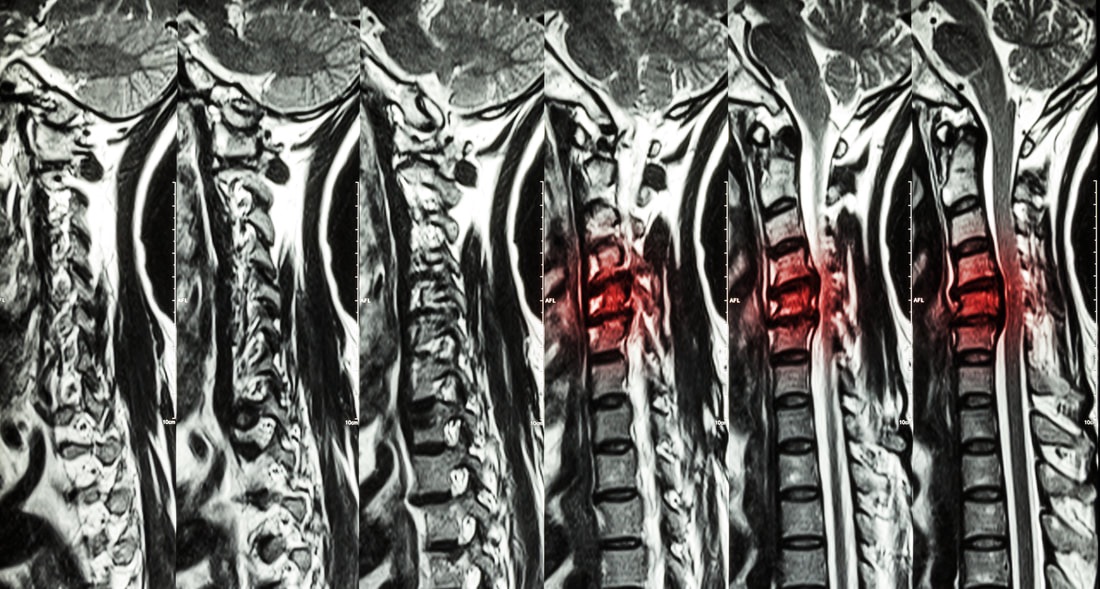 Spinal Stenosis - The Woodlands, TX